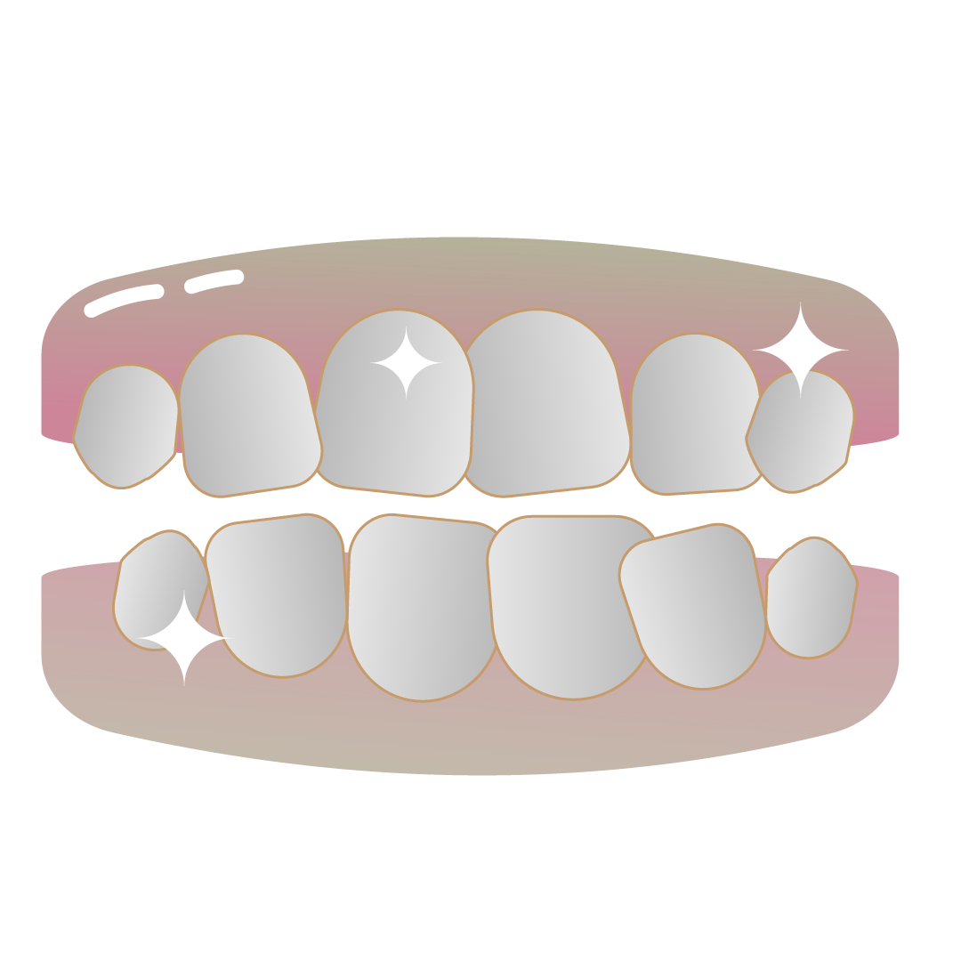 Dentes apinhados